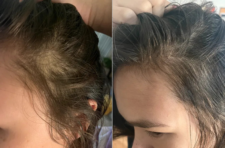 PURE Hair Growth Anti-hair Loss